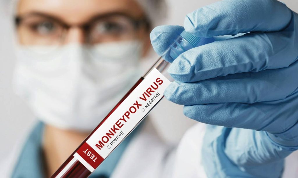 Monkeypox Risk Grows in Faisalabad as Cases Rise to 18